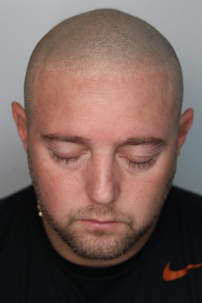 Same client after SMP, from the front: a full, even hairline that reads as fresh stubble
