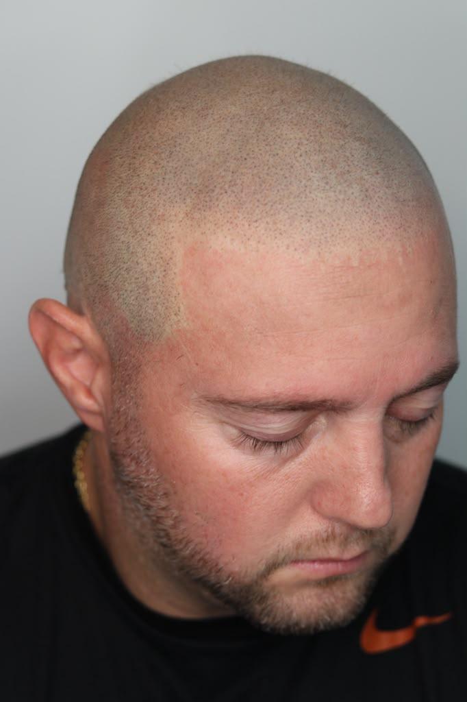 Same client after SMP, from the left: a defined temple and dense, natural coverage