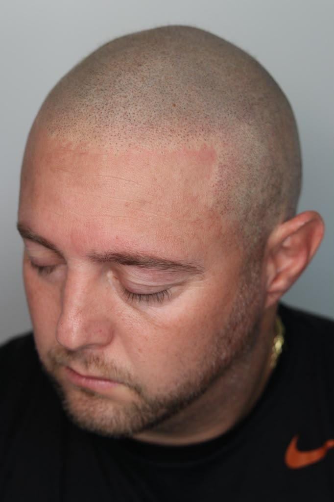 Same client after SMP, from the right: a sharp temple and even crown density