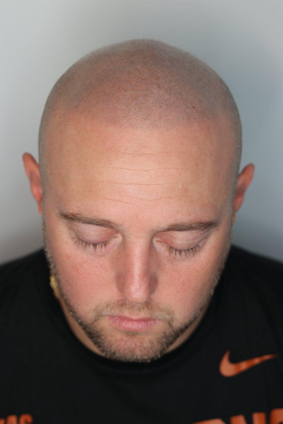 Client before SMP, from the front: receded hairline and bare crown