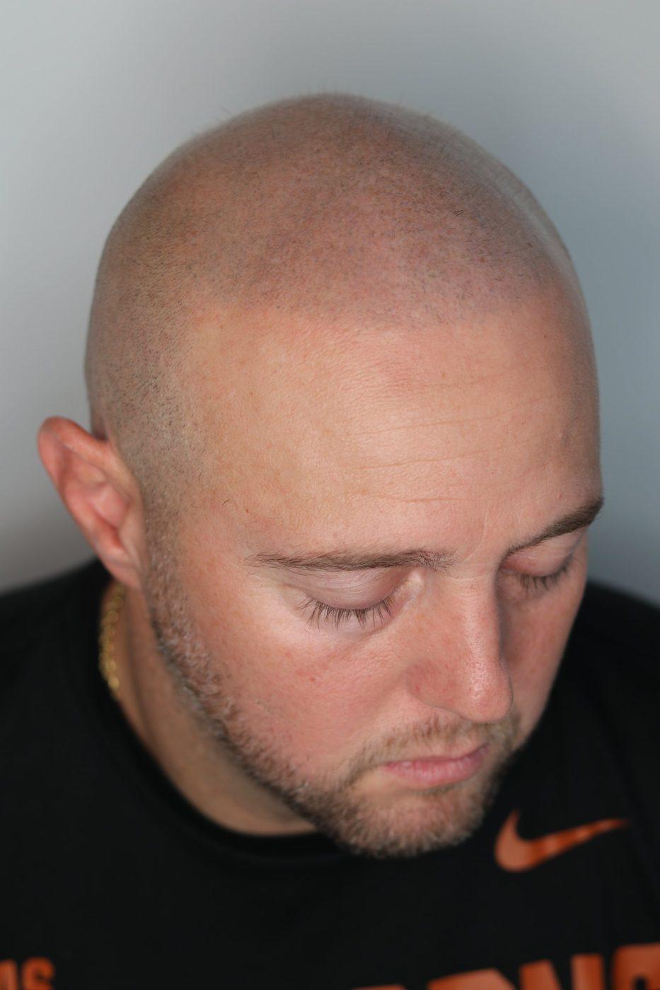 Client before SMP, from the left: thin temple and open hairline